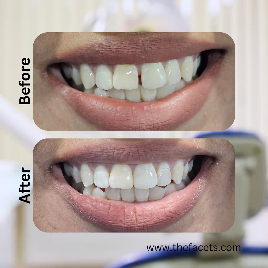 Before and after braces treatment result 7